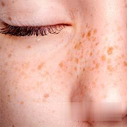Face Freckles